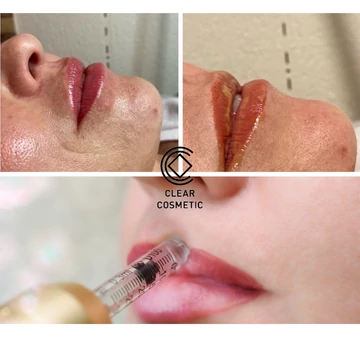 Hialuronsavas ajaktöltés időpont foglalási díj